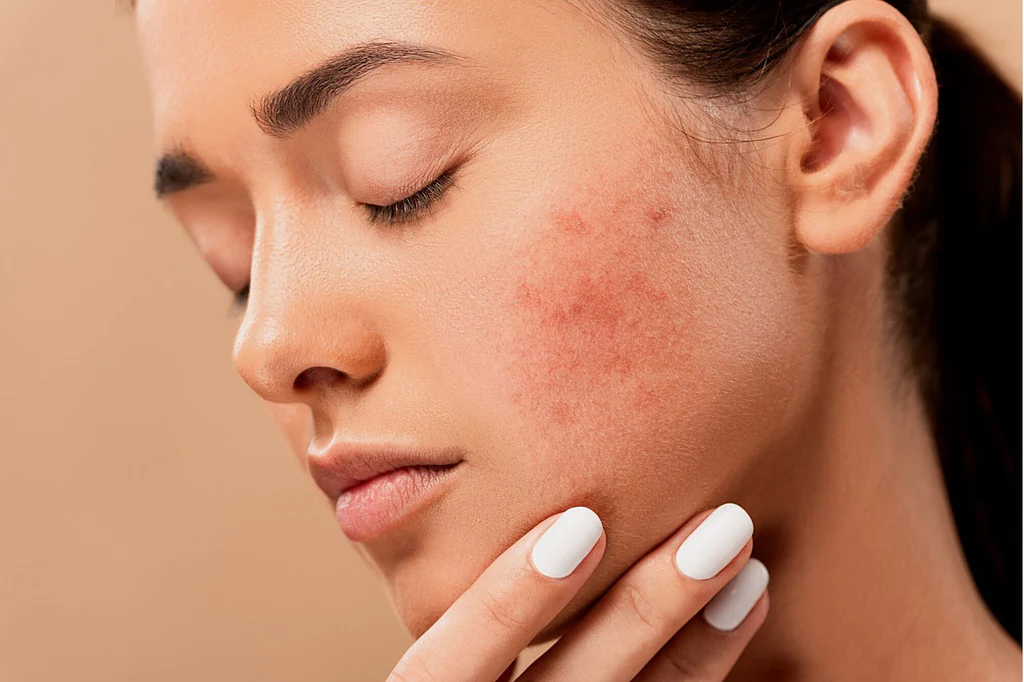 Acne and Acne Scar Solutions using Endymed FSR and Microneedling